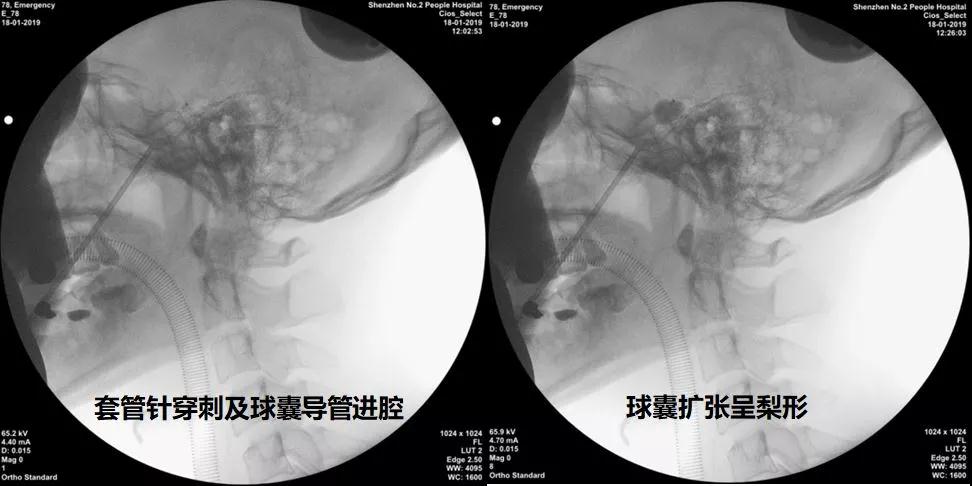 新年将近,ROSA机器人捷报再传!——精准微创小球囊,征服“天下第一痛”