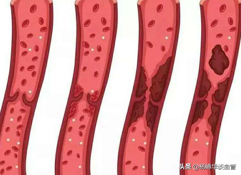 小腿静脉血栓做什么运动好,预防下肢静脉血栓的运动视频