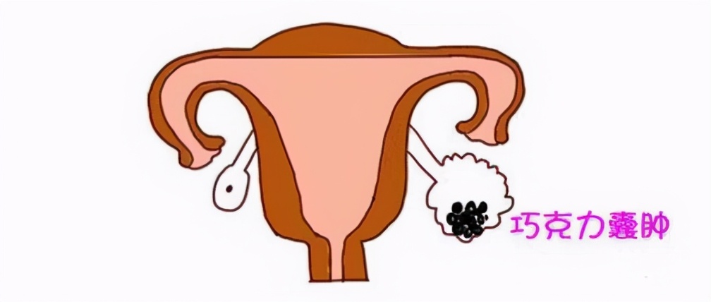 巧克力囊肿到底是什么“糖衣炮弹”?