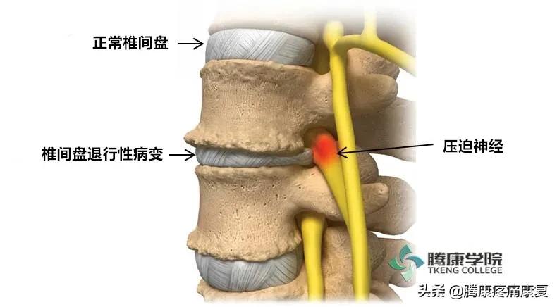 坐骨神经痛是哪个位置图,坐骨神经痛的原因与诊疗