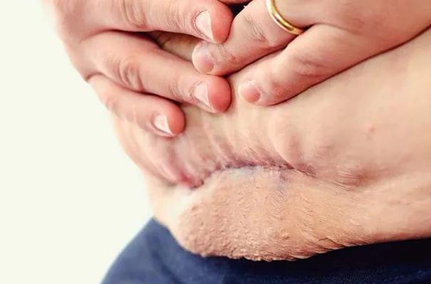 辟谣头胎是剖腹产二胎也必须剖吗,辟谣无痛分娩对胎儿影响大