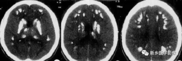 颅内有钙化怎么治疗,34岁脑部有钙化正常吗