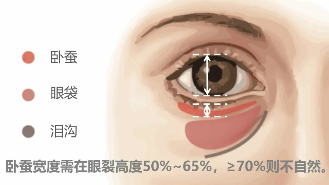 脸部卧蚕什么样,卧蚕都有哪些类型