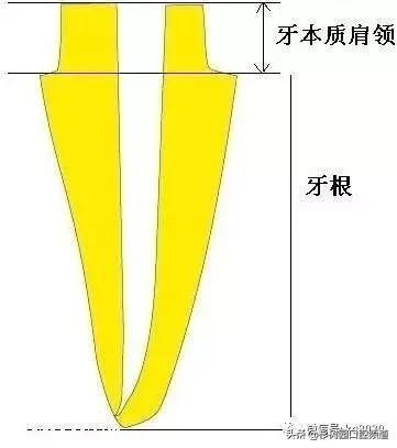 纤维桩的优点和缺点,看完这篇文章就明白了