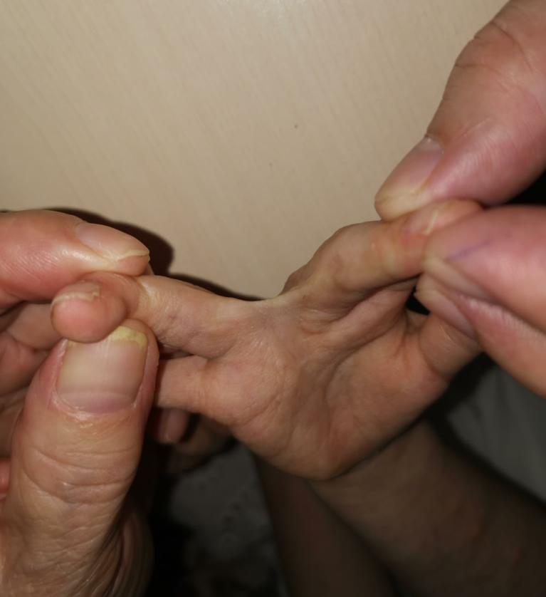 并指畸形免植皮案例,并指畸形