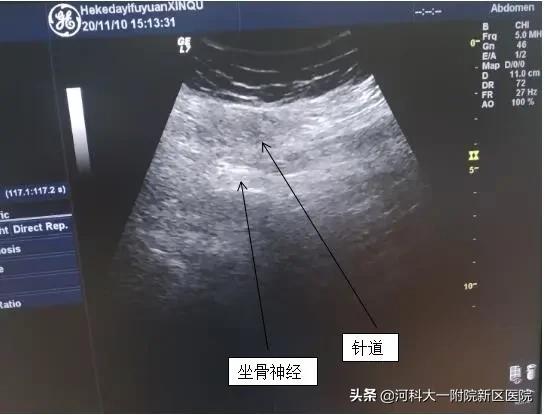坐骨神经痛患者不可不知的“神技”