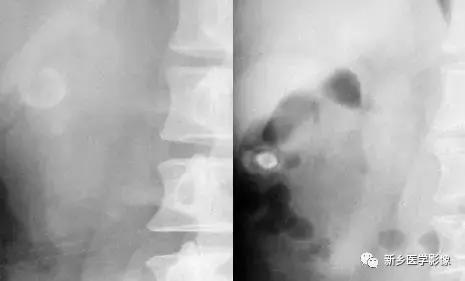 腹部平片可以看出肠胃疾病吗,腹部散在结节状高密度影