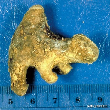 尿路小结石怎么治疗,为什么结石医生不建议做激光