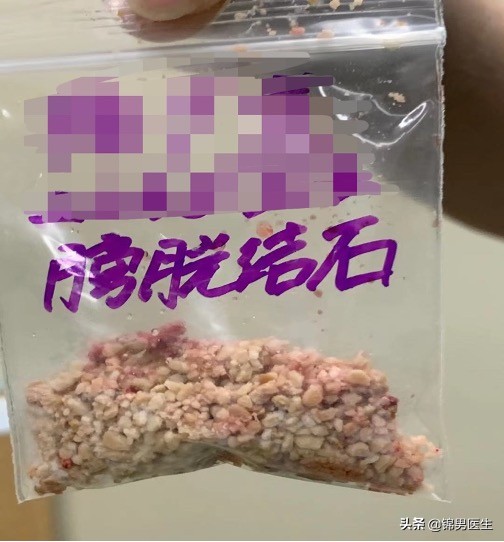 老人小便困难前列腺增生,前列腺增生和结石最好的治疗方法