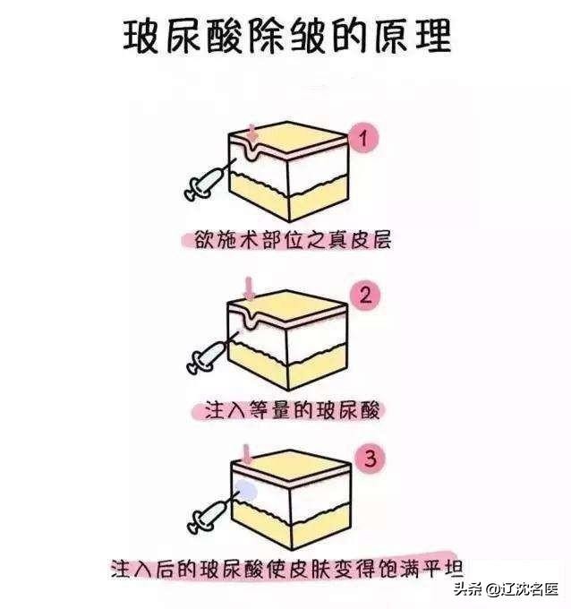 注射玻尿酸美容整形,微整形玻尿酸注射方法图解