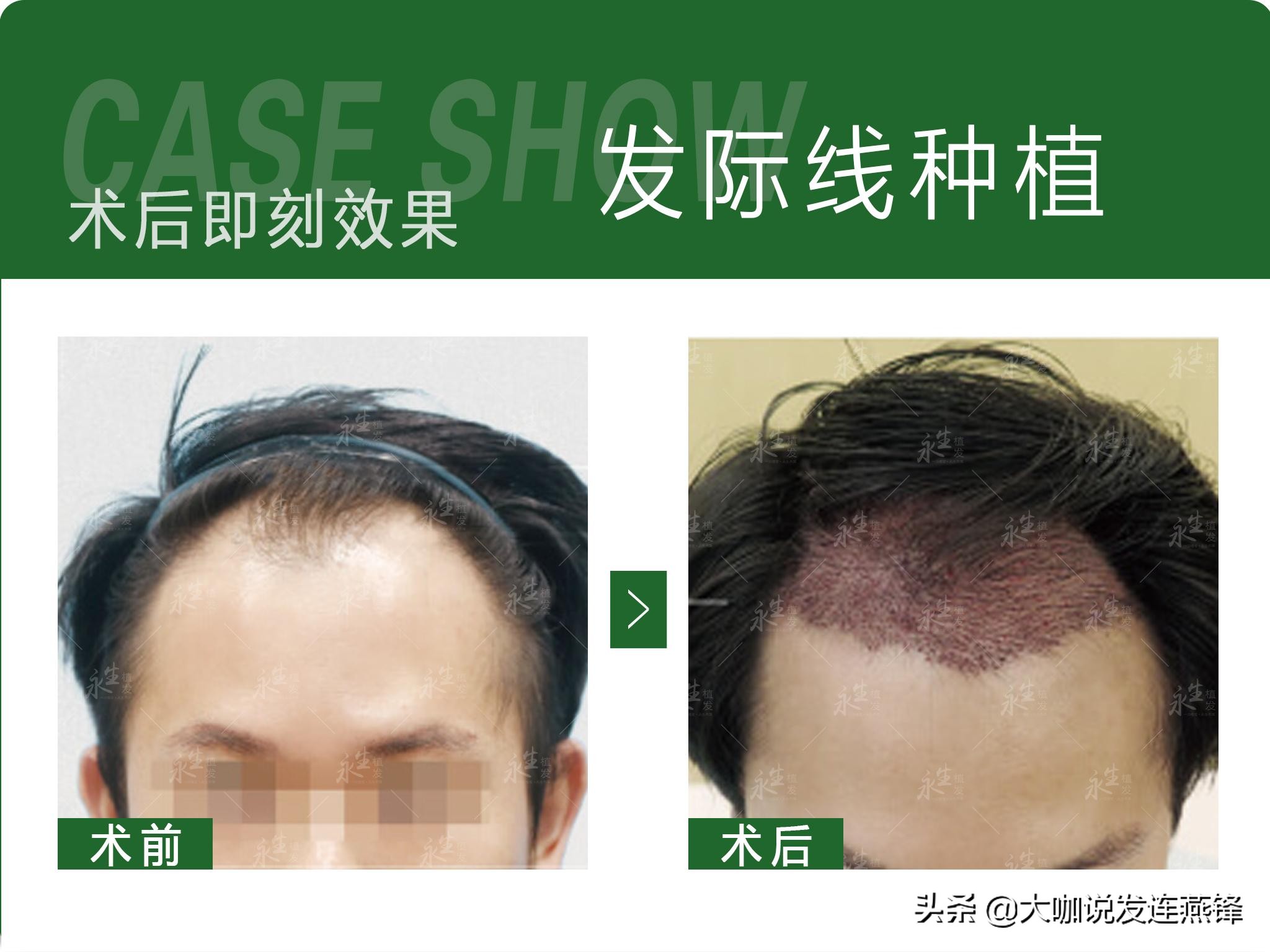 发量少细软适合什么发型免打理,头发稀少发质软塌怎么打理