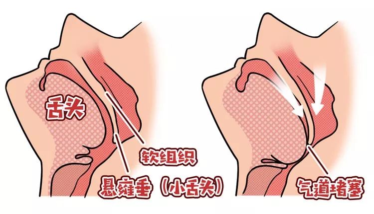 舍友打呼用音响,舍友打呼很大声我要怎么入睡