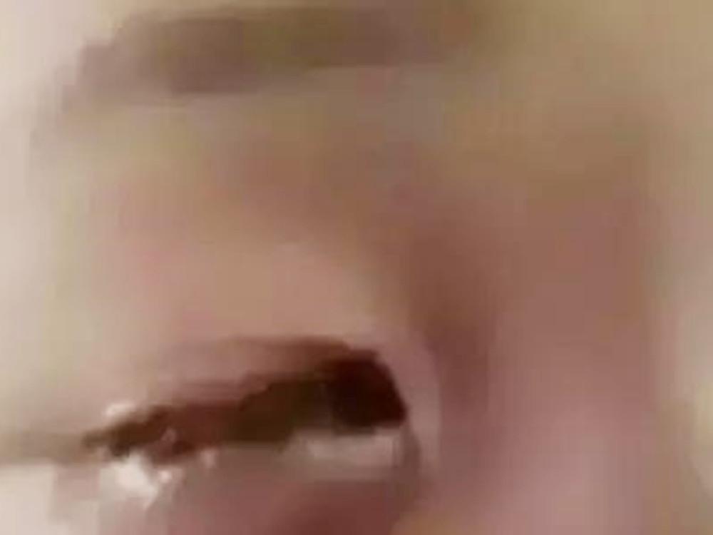 干燥剂爆炸男孩失明,干燥剂爆炸致失明八岁