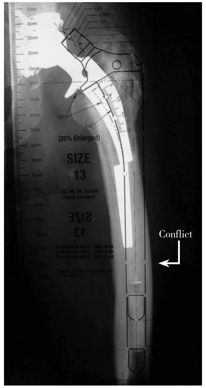 髋关节翻修术手术流程,人工髋关节翻修材料的选择