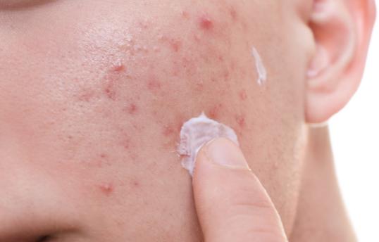 脸上长痘痘怎么办?记好这4个方法,消灭痘痘,皮肤白嫩容颜美