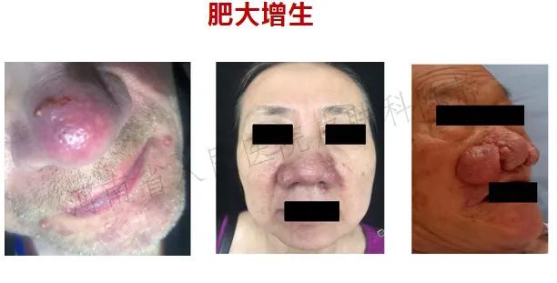 过敏脸上身上全是红痘痘,脸红就是玫瑰痤疮吗