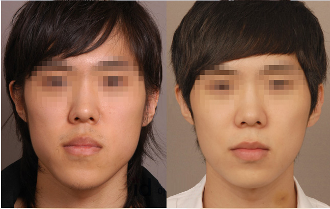 缺牙长期一侧咀嚼嘴巴倾斜,缺牙对咀嚼的影响