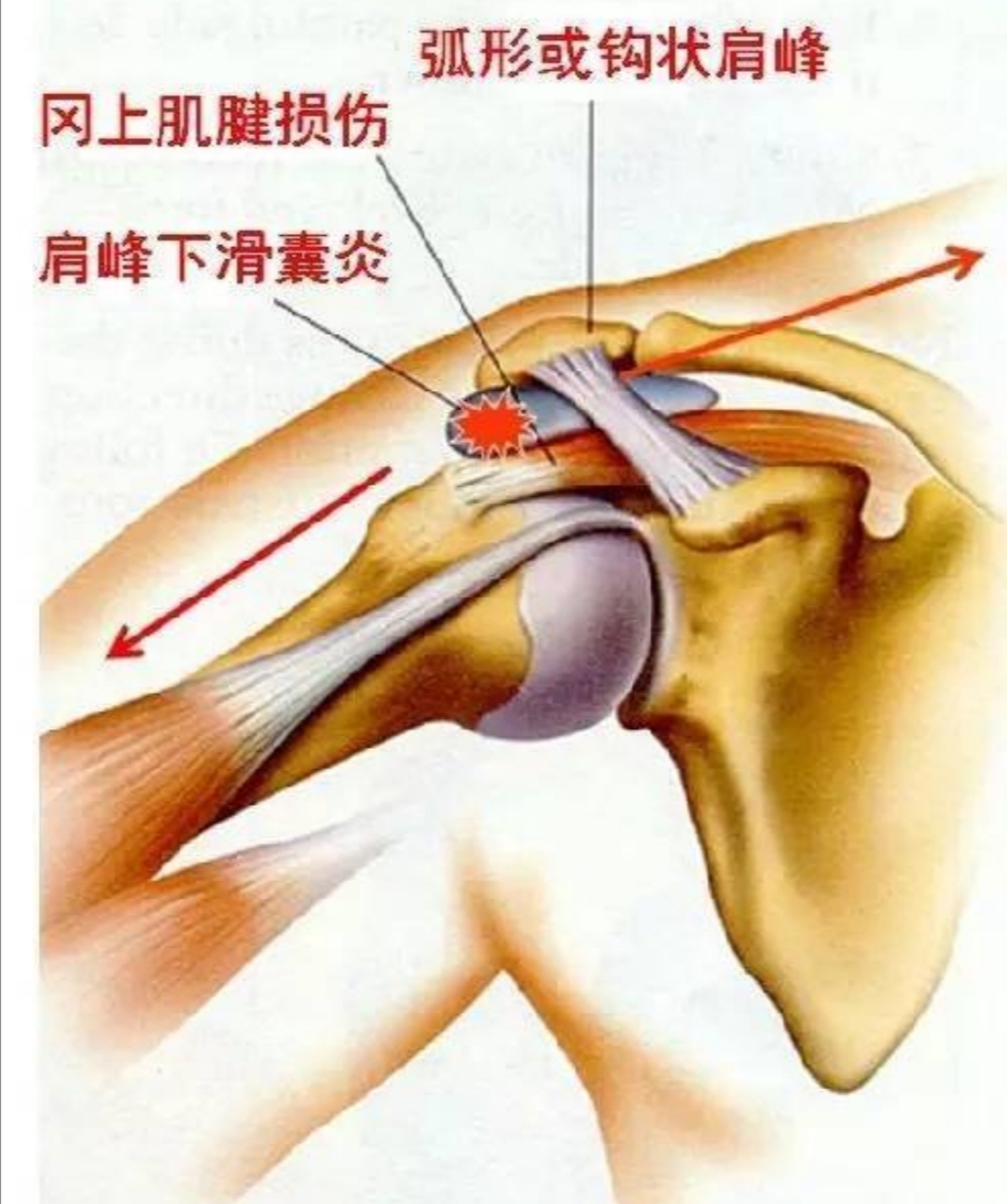 肩峰下撞击会引起什么症状,肩峰撞击导致手臂抬起来疼