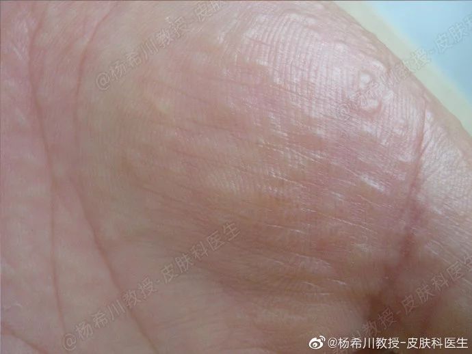 汗疱疹中医解读,专家讲汗疱疹用什么药