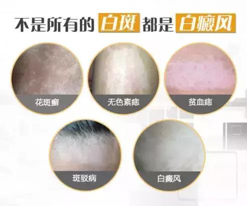 孩子脸花一块白一块怎么回事,小孩脸上花一块怎么回事