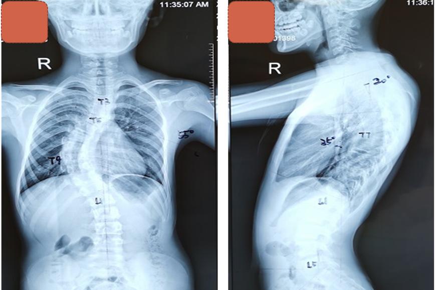 儿童脊髓空洞加脊柱侧弯,合并脊髓空洞的先天性脊柱侧弯