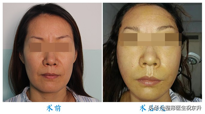 40岁做拉皮手术会年轻几岁,年龄大了做拉皮手术图片