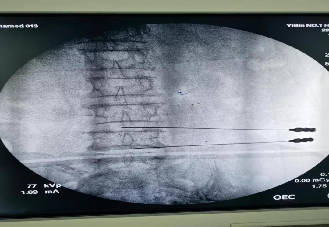 一针治疗腰腿痛视频,一针治疗腰腿痛