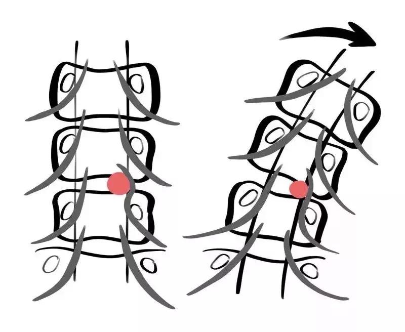 腰突脊柱侧弯最好的恢复方法,腰突为什么会引起侧弯