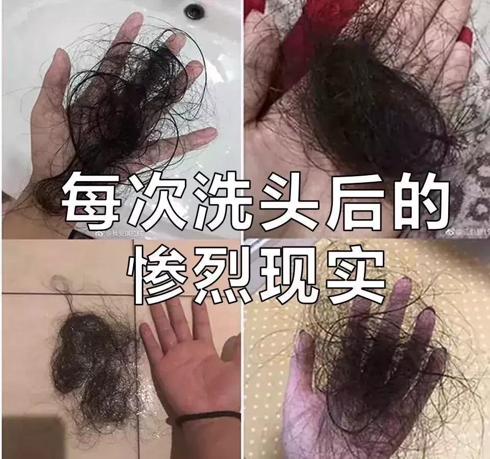 女人脱发,女性其实比男性秃