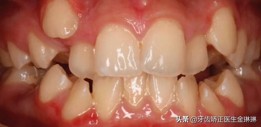 19岁蛀牙牙不齐矫正多久,牙齿拥挤有蛀牙怎么补救