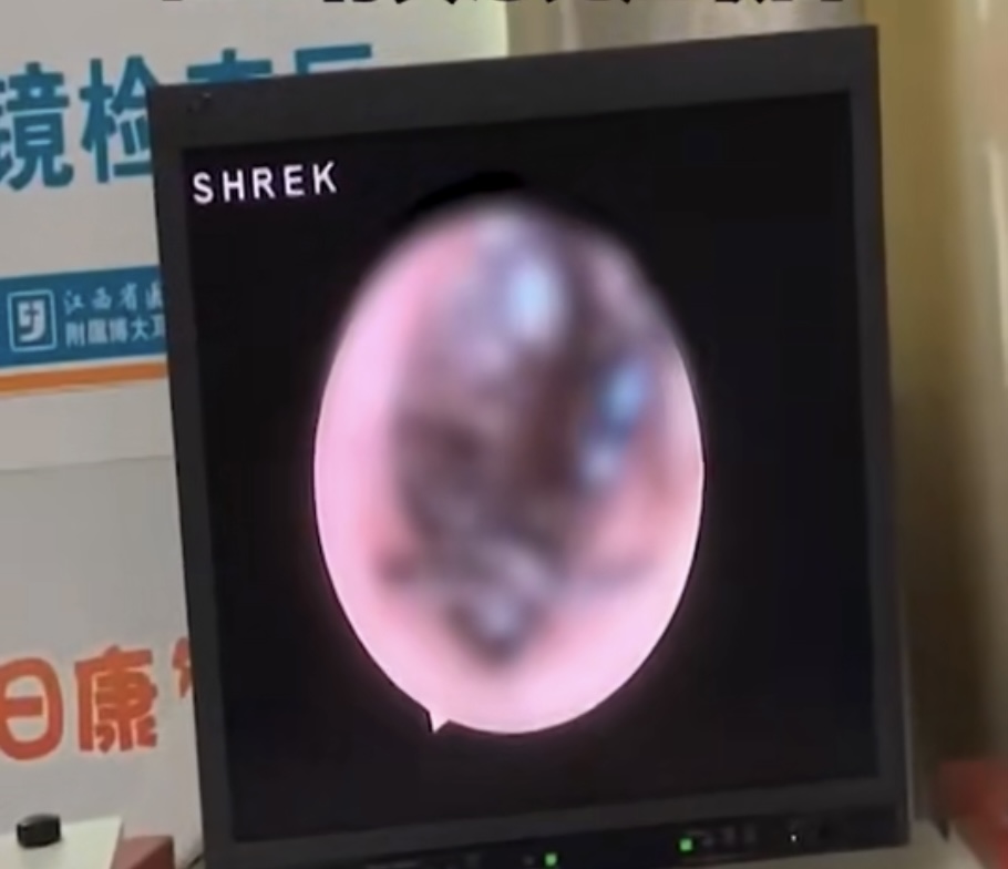 8岁男童在家睡觉耳朵钻进活蟑螂,男童睡觉耳朵钻进活蟑螂全过程