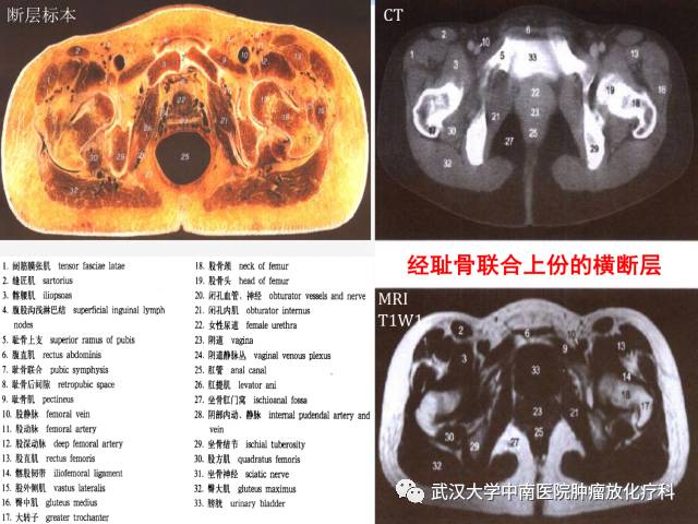 女性盆腔解剖与断层影像