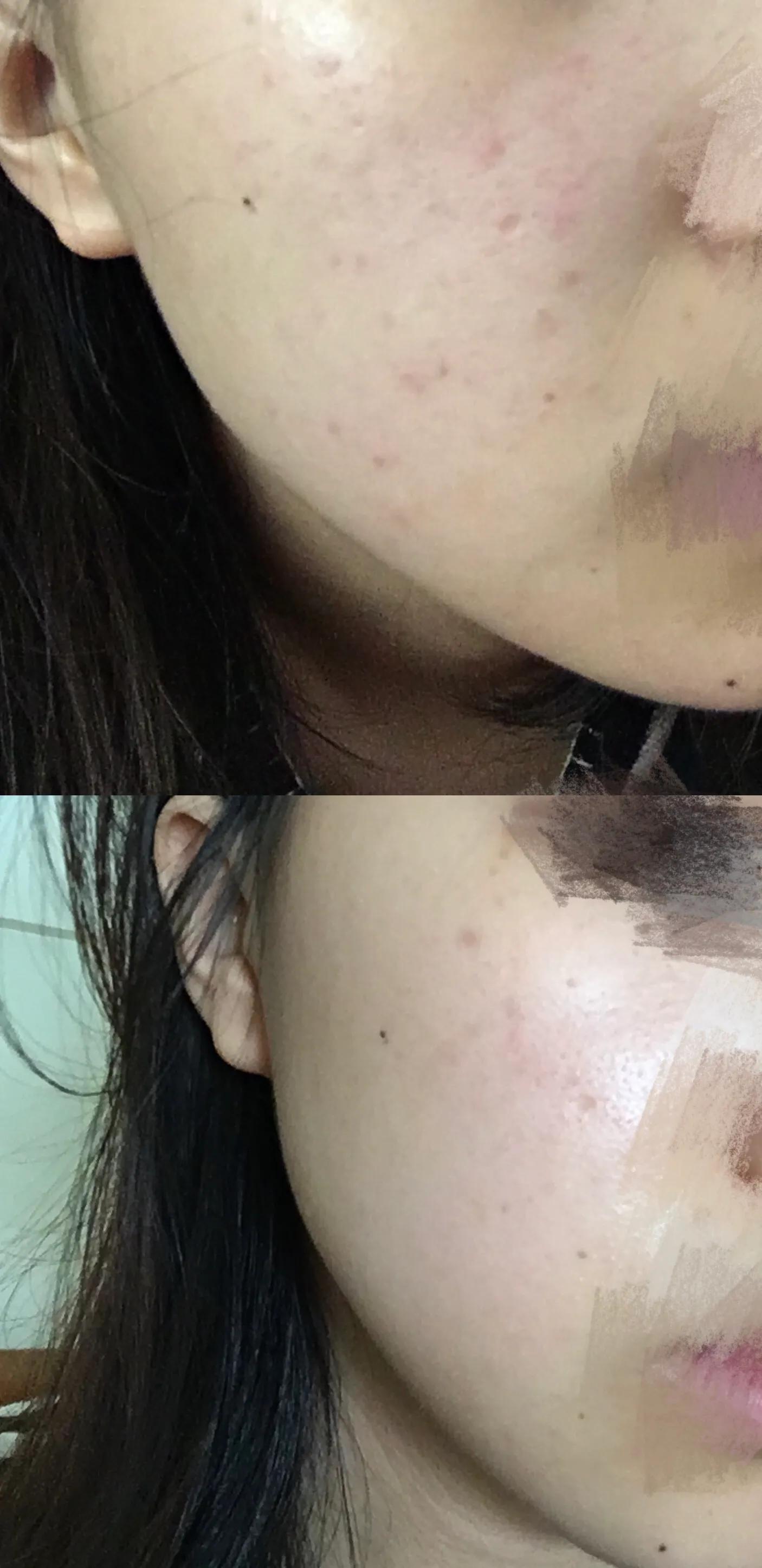 公认最好的祛痘印产品,祛痘印痘坑用什么产品最好