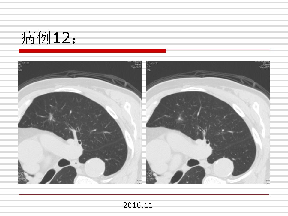 像炎症的肺癌能治好吗,医生说可能是肺癌也可能是炎症