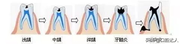 蛀牙哪几种程度可以补牙,如果蛀牙在表面要不要补