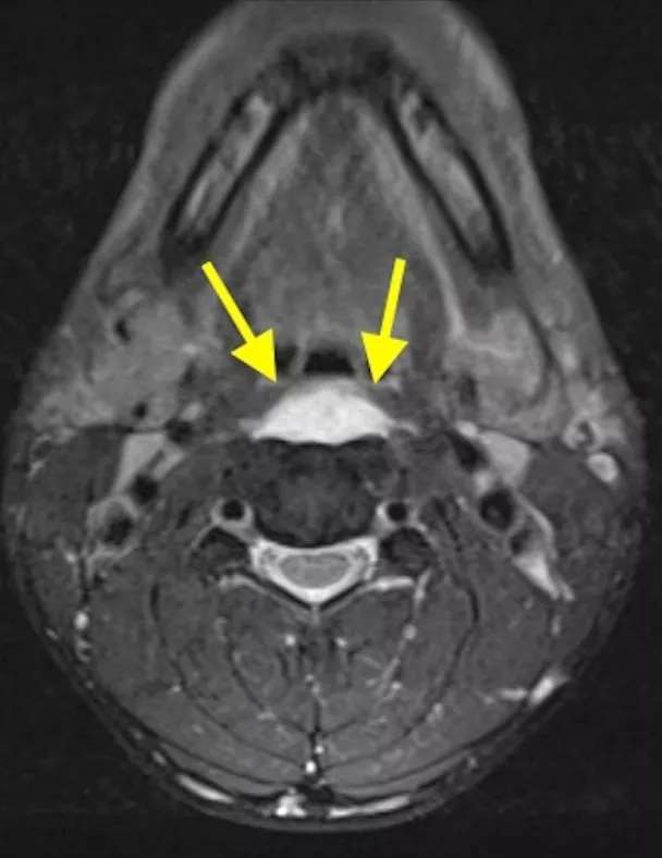 睡醒后脖子酸痛动不了怎么办,睡醒脖子痛不能扭头起身困难