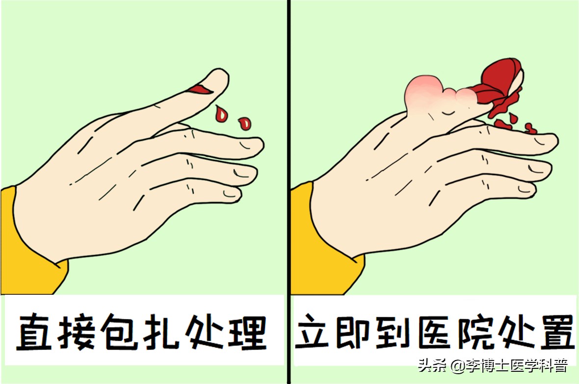 手部外伤急救,手部外伤家庭急救手抄报