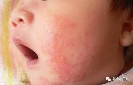 宝宝出现湿疹的原因和护理措施,高烧湿疹的症状及治疗方法