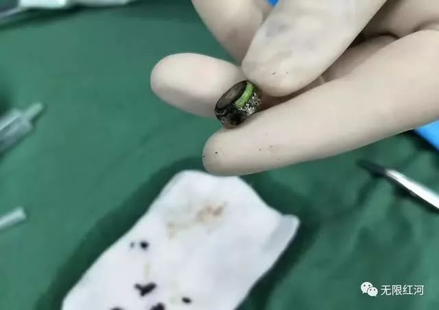 喝了爸爸一碗粥，一岁多孩子肠穿孔..医生曝光原因让所有人震惊