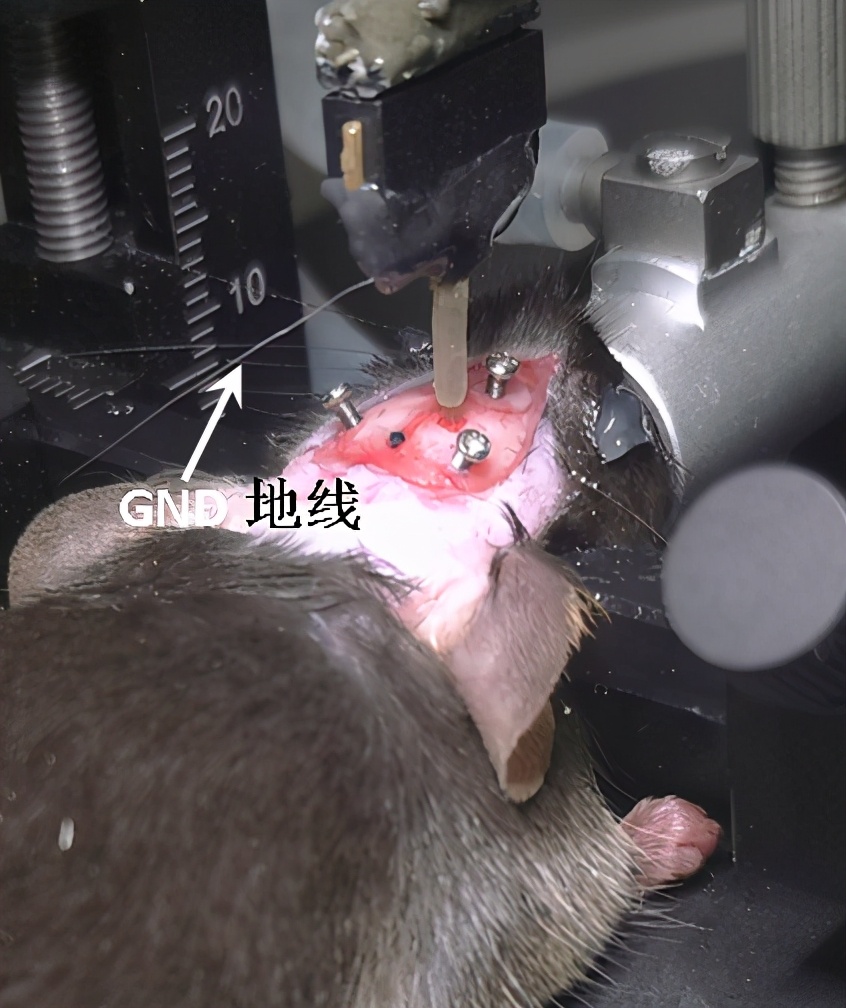 晶体植入手术的分享,可调微丝阵列电极