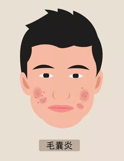 毛囊炎是一个圆形的红疙瘩,毛囊炎起一个很痒的痘