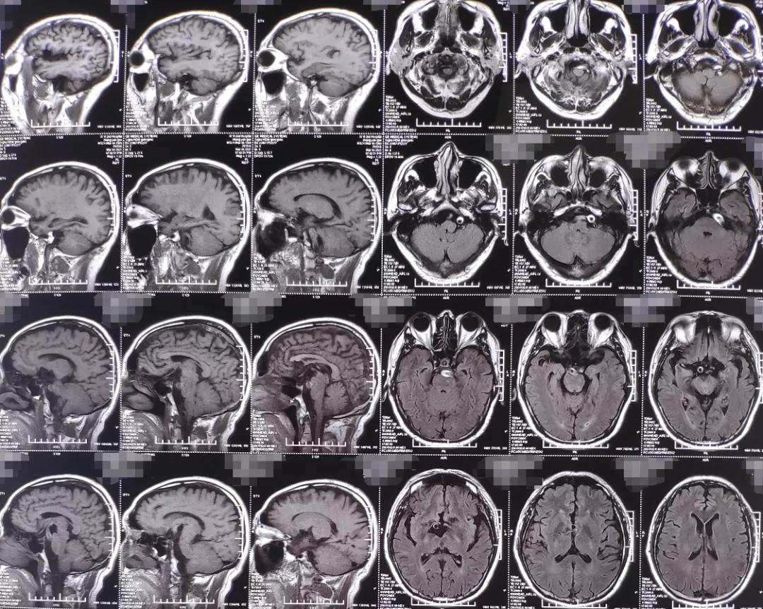 面肌痉挛球囊压迫和微血管减压术,微血管减压术治疗三叉神经痛