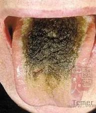 黄苔怎么造成的,黄苔一定是实热吗