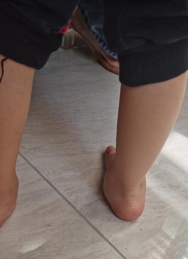 足外翻图片和治疗方法,足外翻需要治疗吗