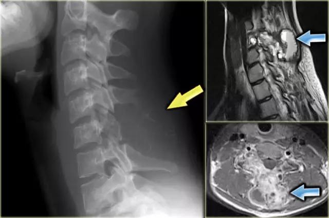 9种骶骨肿瘤,溶骨性恶性肿瘤