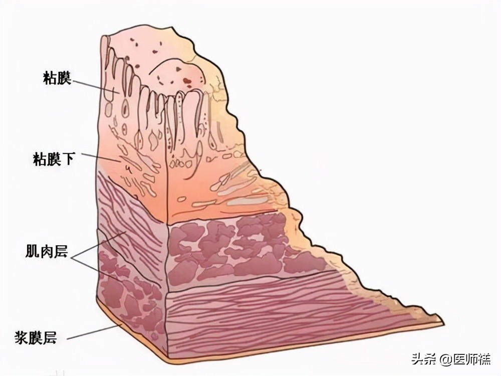 胃炎久治不愈查肿瘤标志物正常,胃炎一直拖着不治