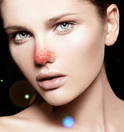 草莓鼻和非草莓鼻有什么区别,草莓鼻怎么消除最干净学生