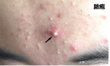 宅家的1个多月都没化妆,竟然还爆痘