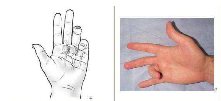 手指腱鞘炎怎么治好得快,手指腱鞘炎怎么办最快最有效