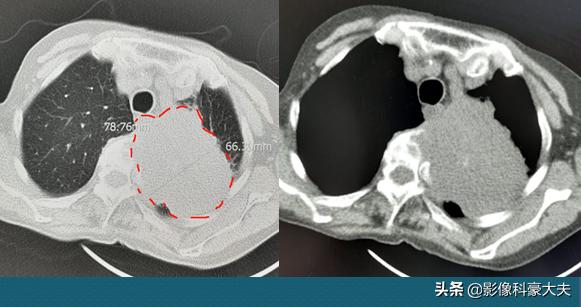 三种情况发现是肺癌晚期,晚期肺癌不咳嗽爱睡觉是怎么回事